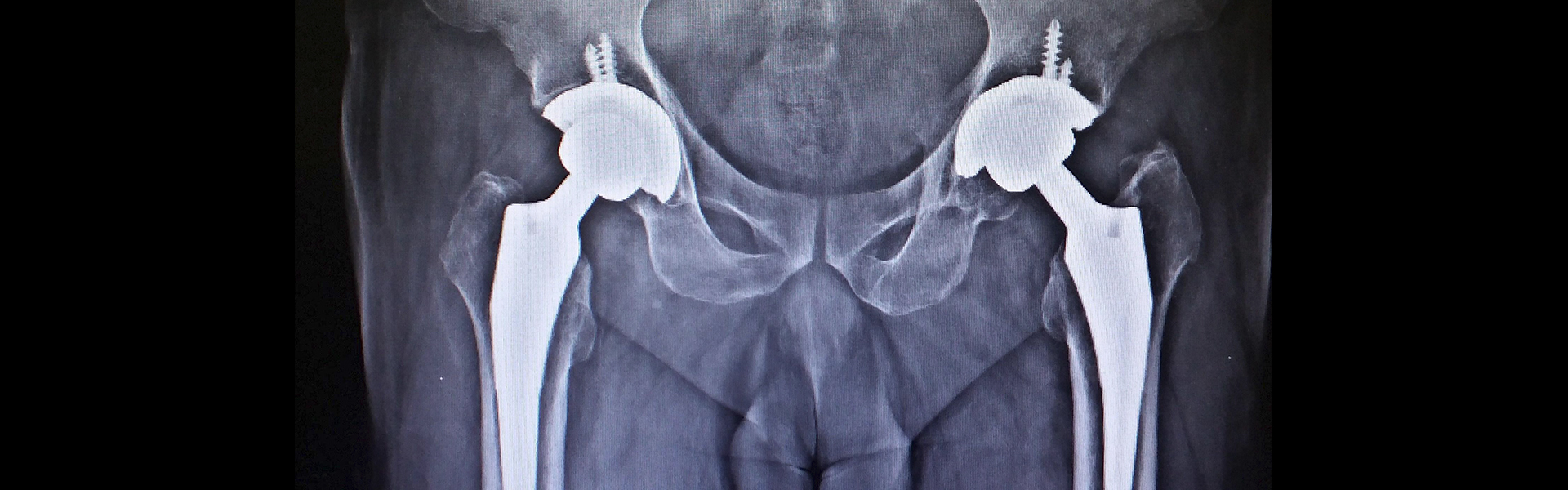 Joint Replacement