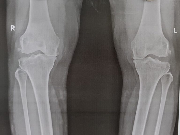 Knee Replacement Surgery Patankar Ortho Care